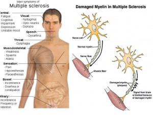Vitamin D Deficiency and the Progression of Multiple Sclerosis