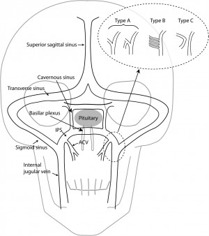 Bilateral inferior petrosal sinus sampling