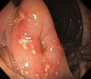 Crohns Ulcer Inflammation