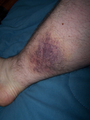 Re: How to get rid of bruises?