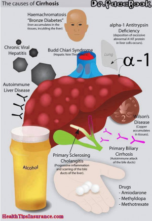 Causes Of Liver Cirrhosis