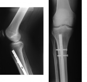 Intramedullary rod insertion – Femur Fracture