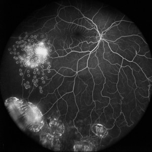 Non-Contact Ultra-Widefield Angiography Images for SPECTRALIS®