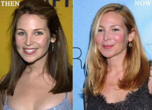 Grey Plastic Surgery Before