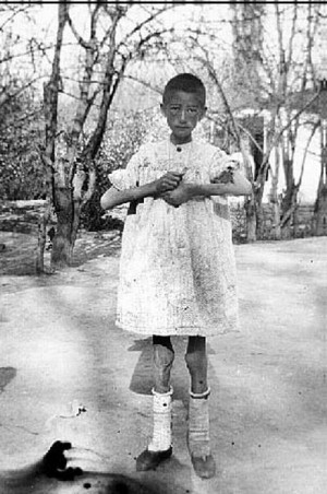 Refugee orphan at Erivan. Like many others, she carried the marks of ...