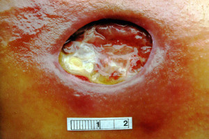 Related Pictures aphthous ulcers tongue halo 4 armour permutations ...