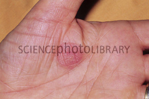 Burn Blisters On Hands