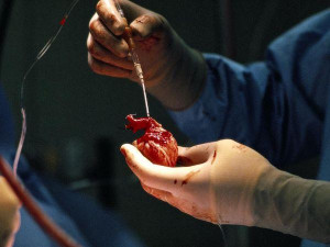 Real Human Heart Surgery Heart & brain pictures