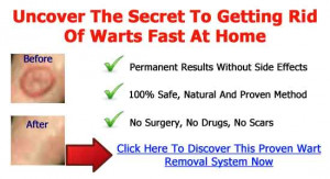how to get rid of water warts