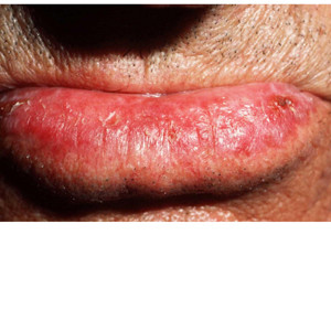 Actinic chelitis – sun-damaged lips | My Skin Cancer Centre