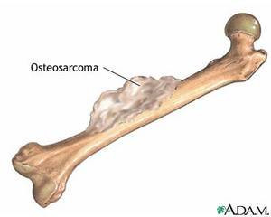 bone cancer Images and Graphics