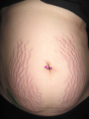 Stretch Marks are making me miserable