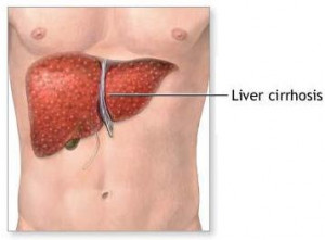 india_liver_transplant_diseased_Liver.jpg