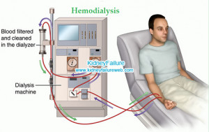 Person Dialysis