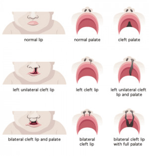 What are cleft lip and palate surgeries?