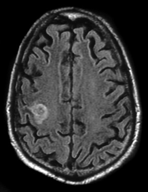 Mri Brain Scan Results Lesions