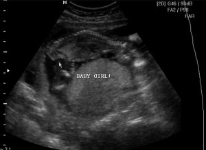ultrasound at 13 weeks pregnant