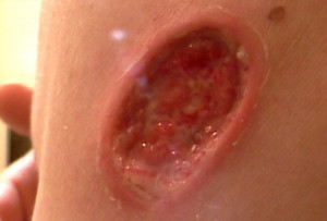 Images, Pics, Pictures and Photos of Melanoma Skin Cancer