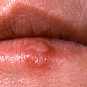 fever blister tags fever health medical blister fever blister