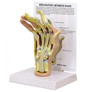 ... Spine Fusion In Rheumatoid Arthritis Care Carlsbad California remedies