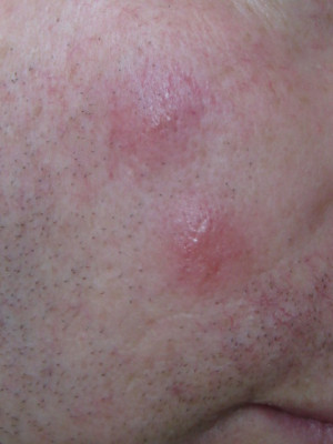 Bug Bites On Skin