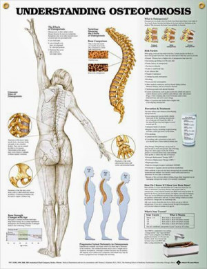 Osteoporosis anatomy poster shows anterior, lateral and posterior ...