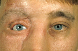 Neurofibromatosis Images