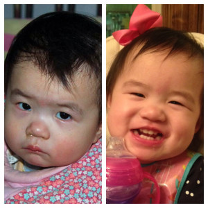 Hannah in the orphanage (left) and Hannah today (right)