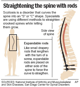 exercises for mild scoliosis