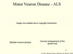 Als Motor Neuron Disease