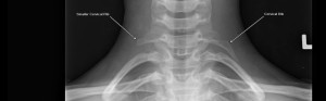 The significance of cervical ribs in thoracic outlet syndrome