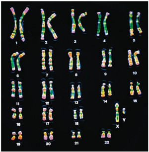 Sickle Cell Anemia Karyotype