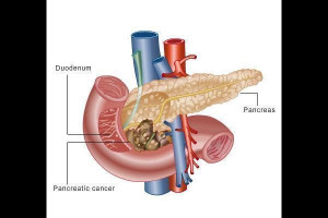 Pancreatic cancer Picture Slideshow