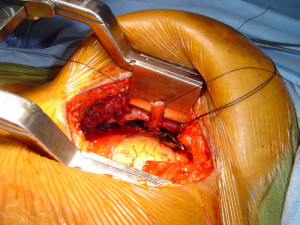 ... invasive coronary artery bypass surgery left internal mammary