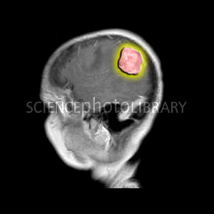 Mri Brain Lesions Pictures