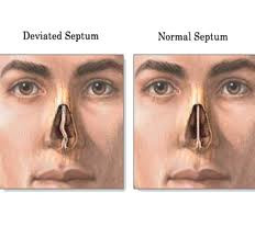Deviated Septum Deviated septum