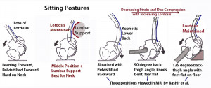 These are some of Overing Chronic Neck Pain Postural Causes And Unique ...