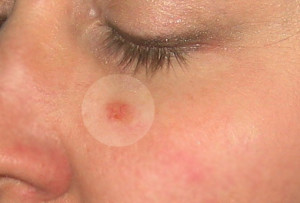 Early Skin Cancer On Face