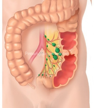 Colon Cancer Signs And Symptoms