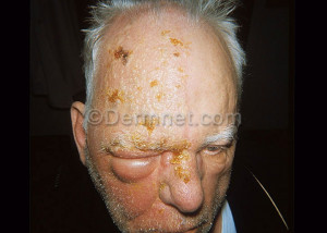 Skin Disease Herpes Zoster