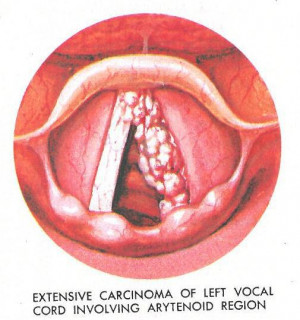 Vocal Cord Polyps Causes Symptoms Treatment And Surgery