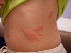 Pictures of Poison Ivy | Posion Ivy Skin Rash Pictures