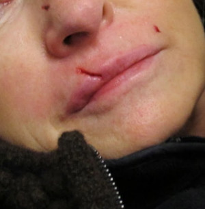 Martha Stewart Gets Stitches After Own Dog Bites Her