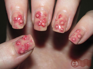 What better use of those nail pearl things, but to make PIMPLES ...