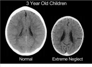 How does Neglect Impact the Brain?