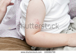 stock-photo-blisters-caused-by-herpes-zoster-in-the-hand-and-arm-of-a ...