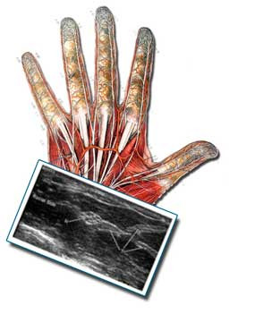 Carpal Tunnel Syndrome Symptoms Diseases And Conditions