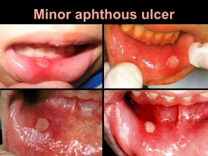aphthous ulcer on soft palate