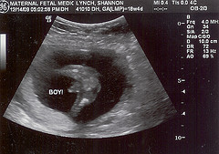 18 weeks pregnant ultrasound boy