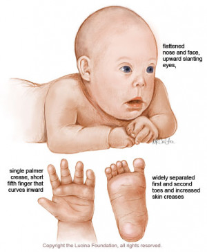 What's a chromosomal abnormality?